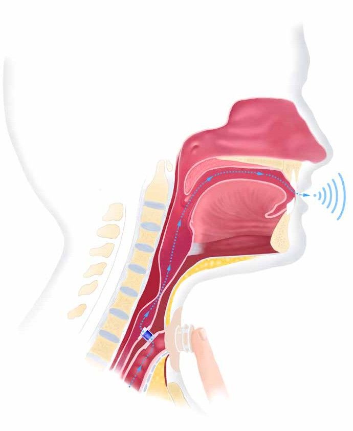 Diagram of air passing from the windpipe through a small valve into the food pipe and up to the mouth while a finger covers the stoma.