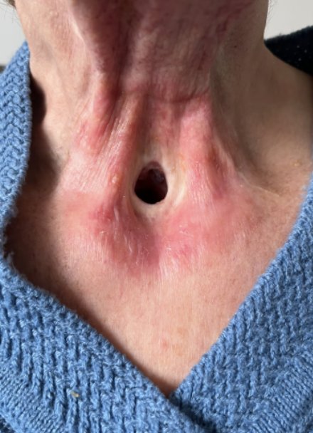 Close-up of the lower neck of a person in a blue knitted jumper, showing a stoma as an opening in the hollow at the base of the throat.